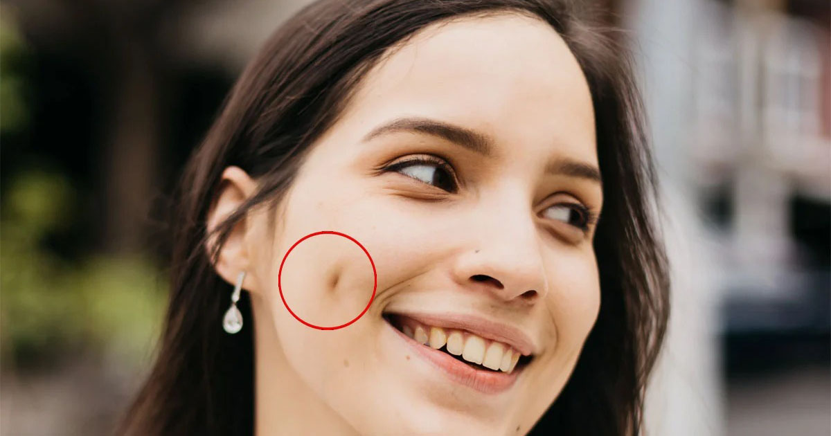 গালে টোল পড়া কি রোগ, নাকি অন্যকিছু!