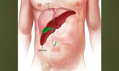 ফ্যাটি লিভার কেন হয়? আক্রান্ত হলে দ্রুত যা যা করবেন ,অবশ্যই জেনেনিন