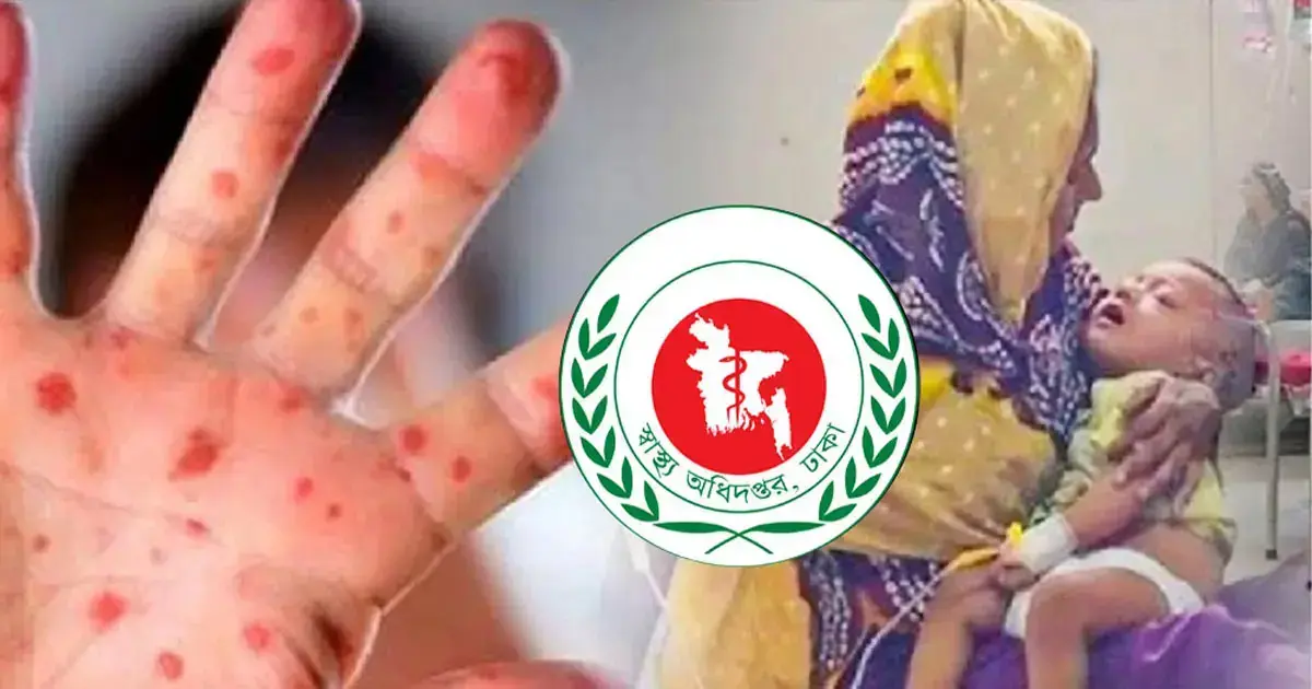 হাম উপসর্গে ২৪ ঘণ্টায় ৪ শিশুর মৃত্যু