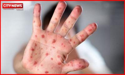 চট্টগ্রামে আরও চার শিশুর হাম শনাক্ত,  এ পর্যন্ত ১৮ জন আক্রান্ত