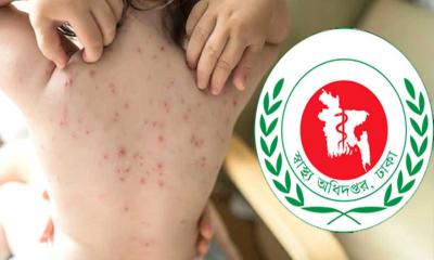 হাম উপসর্গে ২৪ ঘণ্টায় ৪ শিশুর মৃত্যু