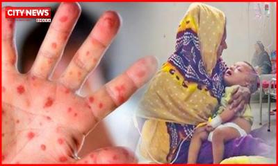 7 die from measles and measles-like symptoms in 24 hours