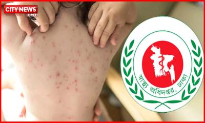 ২৪ ঘণ্টায় হাম ও হামের উপসর্গ নিয়ে ৮ জনের মৃত্যু