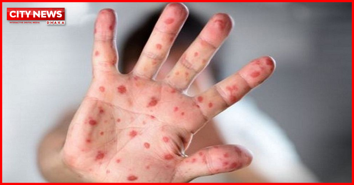 চট্টগ্রামে আরও চার শিশুর হাম শনাক্ত,  এ পর্যন্ত ১৮ জন আক্রান্ত