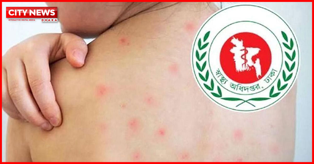 ২৪ ঘণ্টায় হামের উপসর্গে আরও ৪ শিশুর মৃত্যু