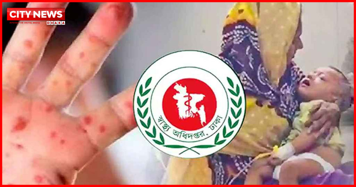 হামের উপসর্গ নিয়ে আরও ৩ শিশুর মৃত্যু