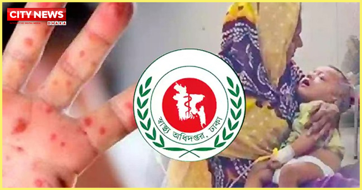 হাম উপসর্গে আরও ৫ শিশুর মৃত্যু