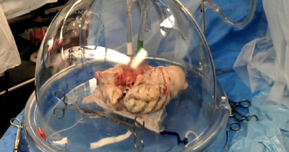 ফুসফুস প্রতিস্থাপন : কলকাতার হাসপাতালের ইতিহাস