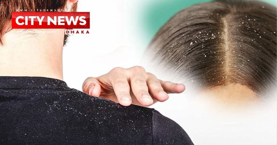 স্থায়ীভাবে খুশকি দূর করতে রসুনের ৫ ব্যবহার