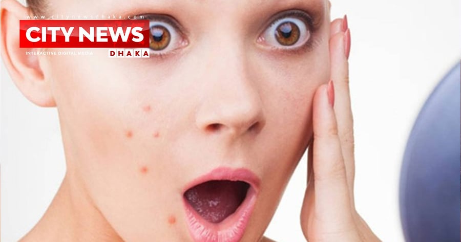 ঘরোয়া উপায়ে ব্রণের সমস্যা সমাধান