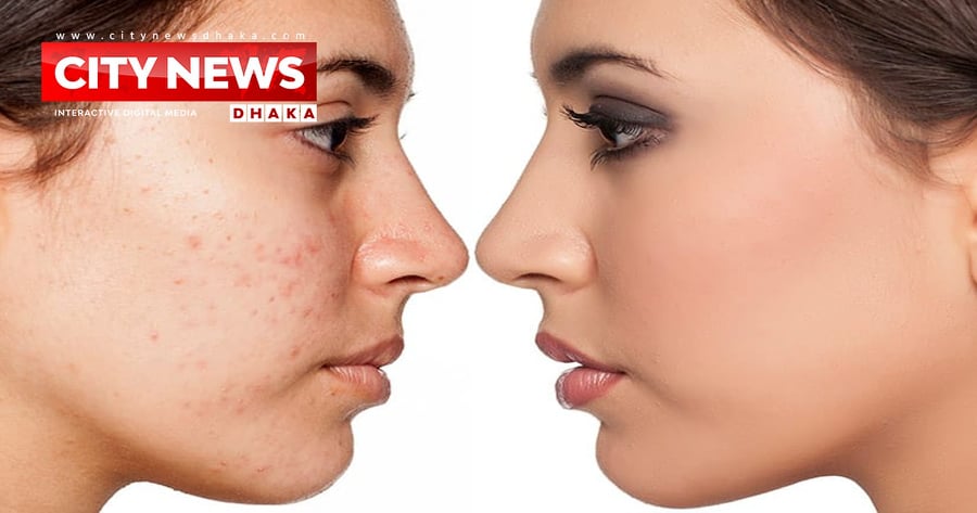 ব্রণের দাগ দূর করার ৩ উপায়