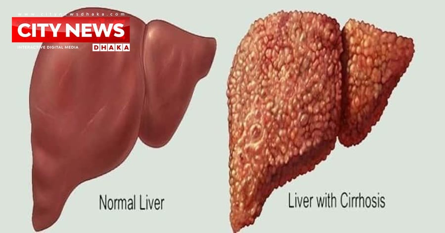 বাংলাদেশে সিরোসিসের প্রধান কারণ