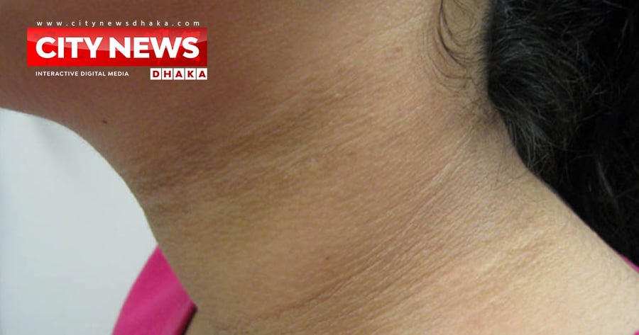 গলার কালো দাগ তুলতে যা করবেন