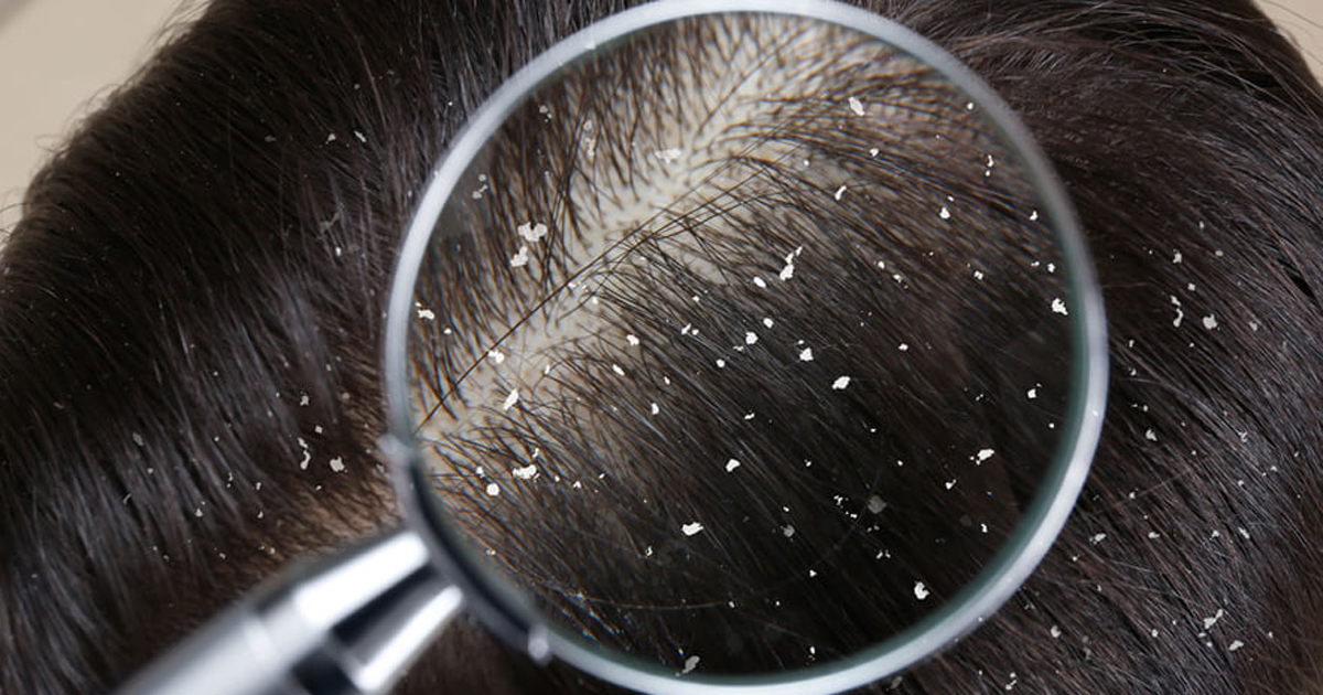 খুশকি দূর করতে পেঁয়াজের রসের ব্যবহার