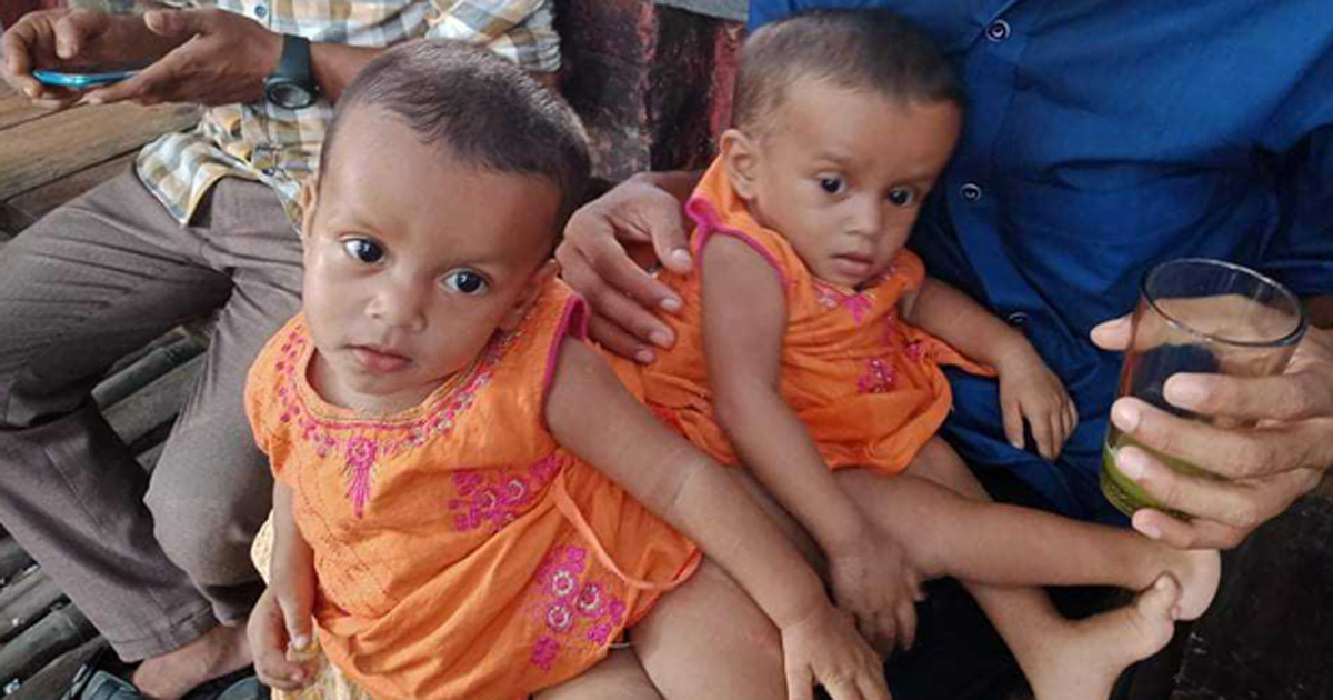 ‘নীলফামারীর জোড়া শিশুদের আলাদা করা সম্ভব নয়’