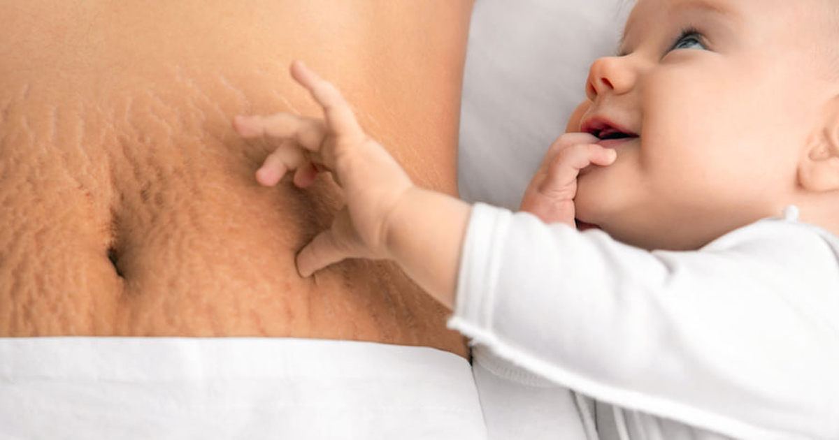 Ways to remove cracked marks on body