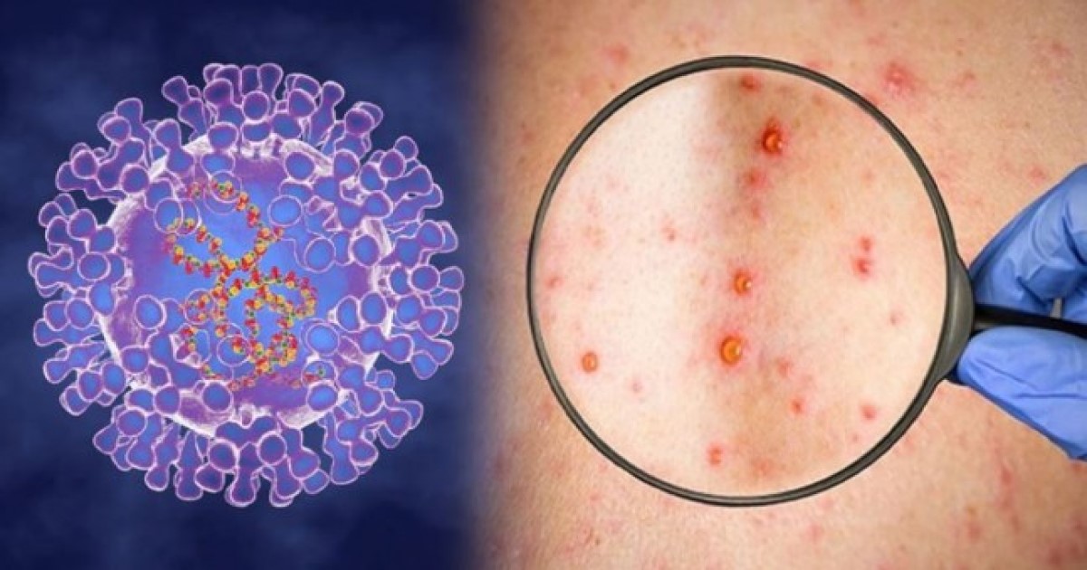 আমিরাতসহ আরও তিন দেশে মাঙ্কিপক্স শনাক্ত