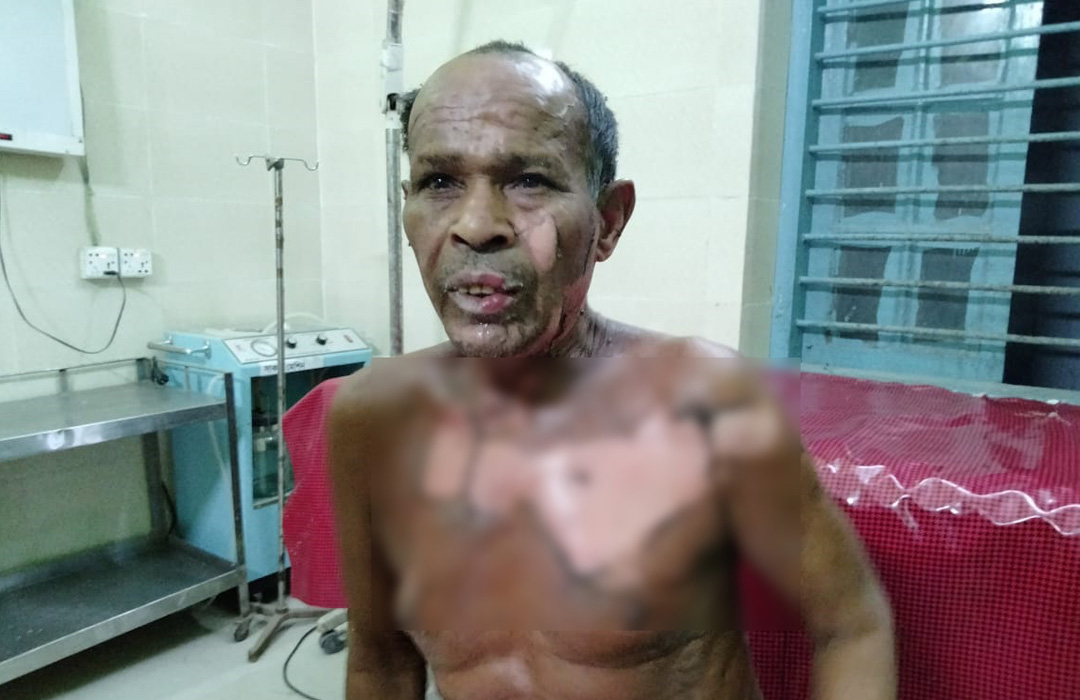 ঝিনাইদহে প্রতিবন্ধীর গায়ে আগুন দিল দুর্বৃত্তরা